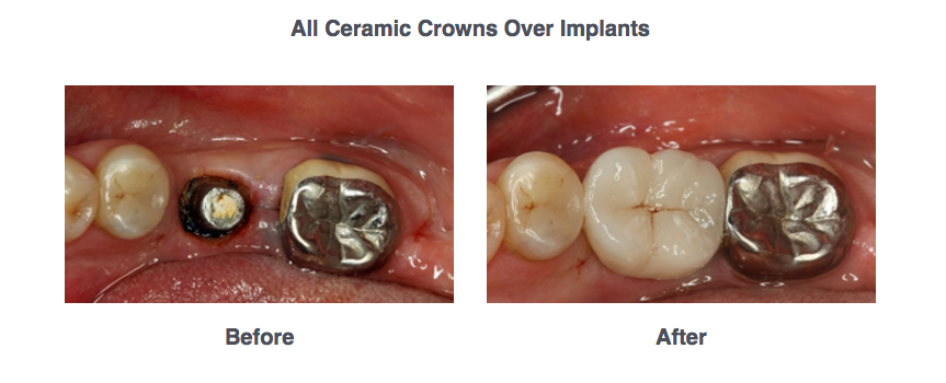 Dental Implants BnA